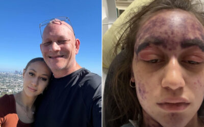 California Woman Claims Hospital Pressured Her to Vaccinate Before Treatment, Leading to a Horrific Adverse Reaction that Has Left Her Fighting For Her Life