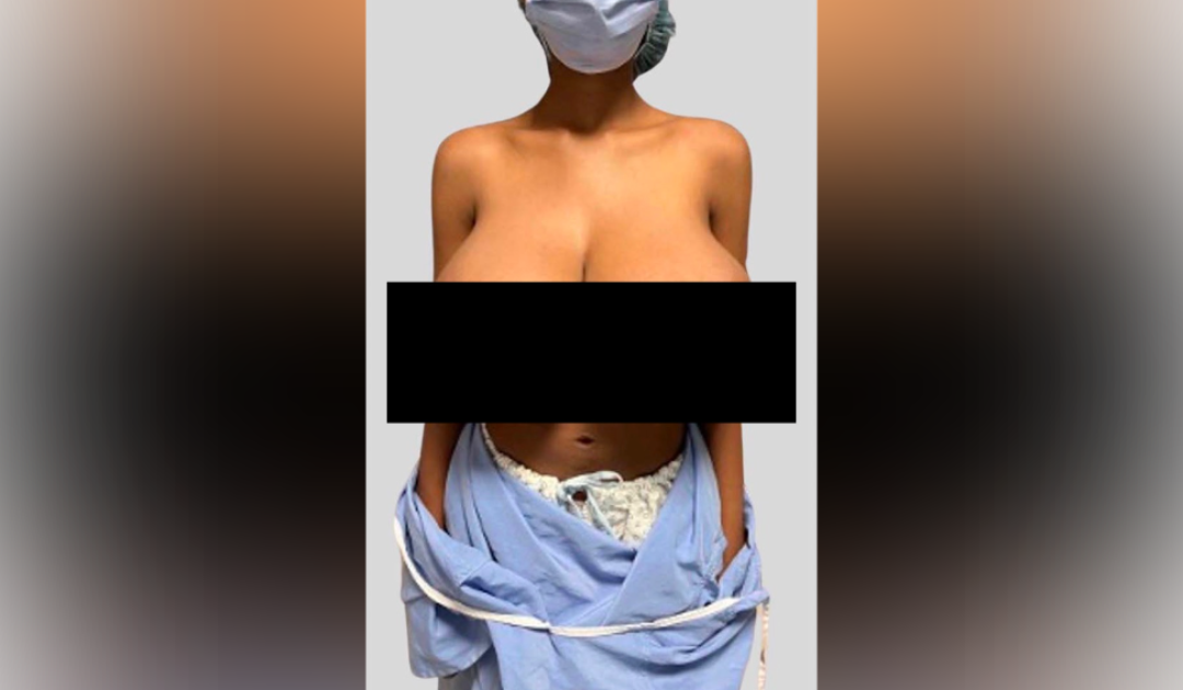 19-Year-Old’s Breasts Balloon from B Cup to Triple G After Pfizer COVID-19 Vaccine — Researchers Call It First-of-its-Kind Case